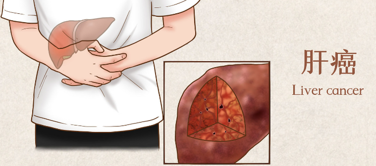 中山大学肿瘤防治中心揭示：免疫细胞治疗，助最高发的 5 大癌症患者重获新生！