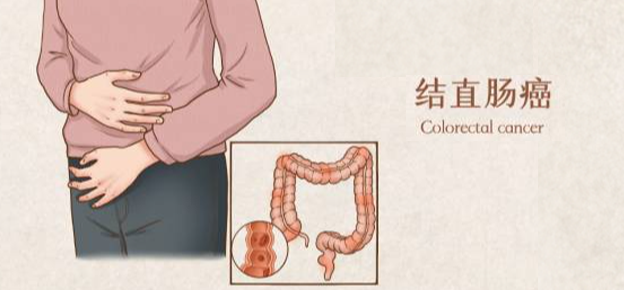 中山大学肿瘤防治中心揭示：免疫细胞治疗，助最高发的 5 大癌症患者重获新生！