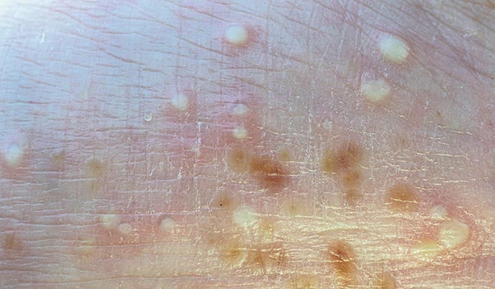 脓疱型银屑病的症状及治疗