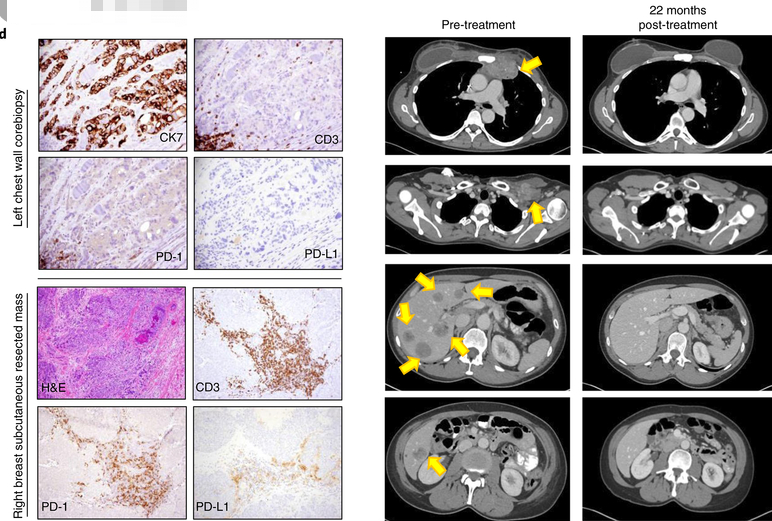 免疫治疗科普 | 常见免疫细胞疗法有哪些？不同免疫细胞疗法有何差异？