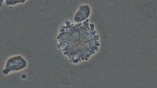 回输 NK 细胞很必要！北京协和医院分析 1068 人后证明了