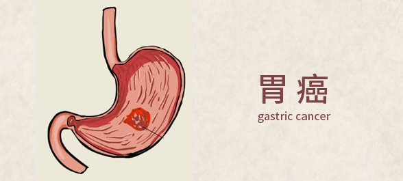 中山大学肿瘤防治中心揭示：免疫细胞治疗，助最高发的 5 大癌症患者重获新生！